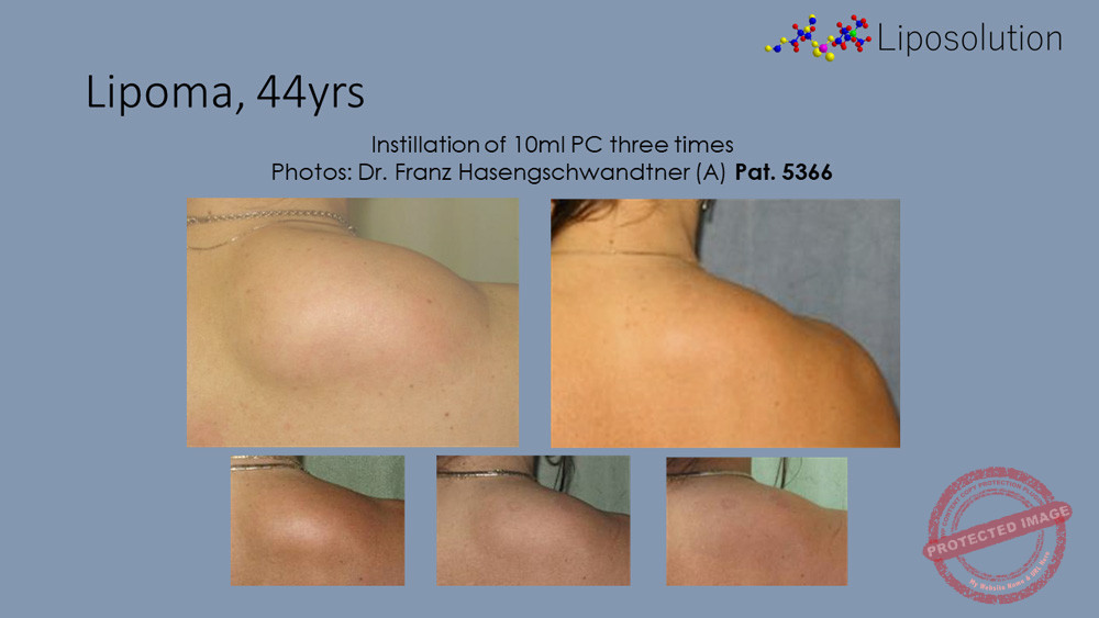 Before and after gallery Liposolution
